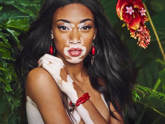 Bazen Kusurlar Avantajdır; Winnie Harlow Bunun Örneği!