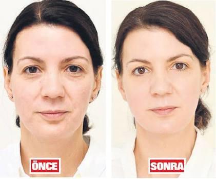 Fondöten Faciasını Önlemek İçin Mükemmel 4 Doğal İksir!