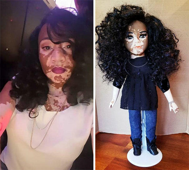 Nadir Cilt Hastalıklarına Dikkat Çekmek İsteyen Sanatçıdan Vitiligo Bebekler!