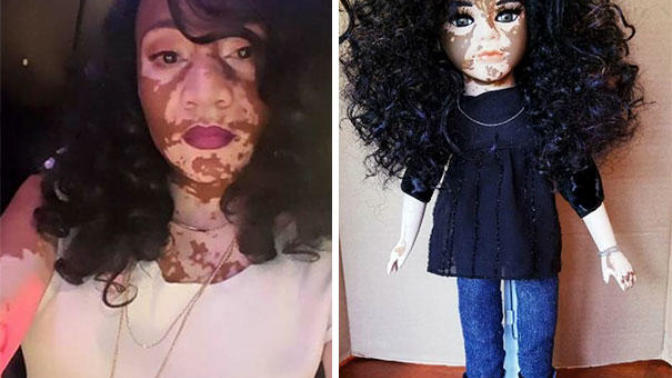 Nadir Cilt Hastalıklarına Dikkat Çekmek İsteyen Sanatçıdan Vitiligo Bebekler!