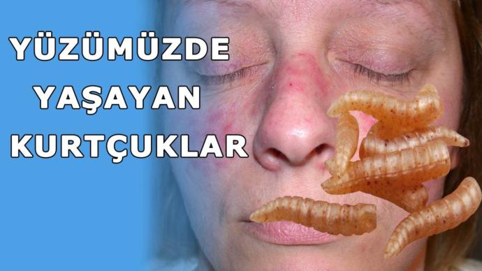 İnsan Yüzünde Yaşayan Kurtçuklar!