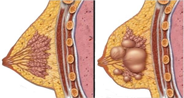 Fibrokistler Kansere Dönüşür mü?