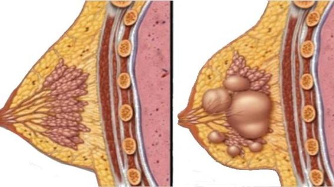 Fibrokistler Kansere Dönüşür mü?