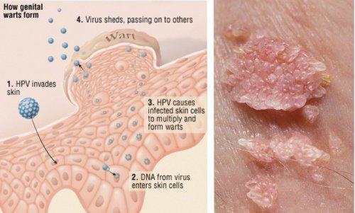 Erken Teşhis Hayat Kurtarır! HPV Virüsü Nedir?