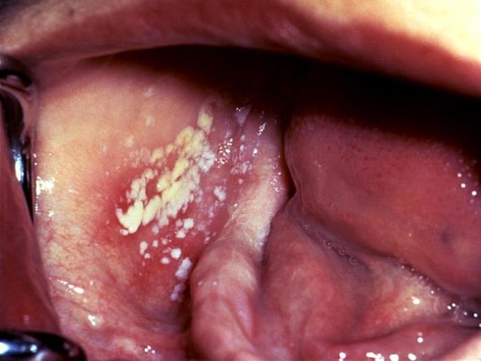 Erken Teşhis Hayat Kurtarır! HPV Virüsü Nedir?