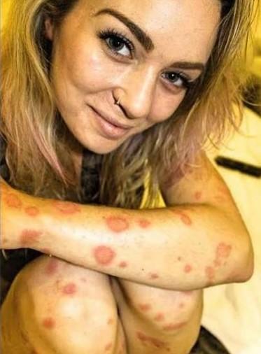 Sedef Hastası Olan ve Bu Hastalıkla Yaşamasını Öğrenen Cesur Bir Kadın: Giorgia Lanuzza!