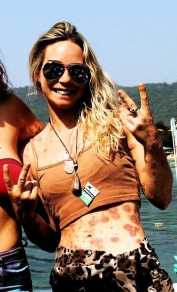 Sedef Hastası Olan ve Bu Hastalıkla Yaşamasını Öğrenen Cesur Bir Kadın: Giorgia Lanuzza!