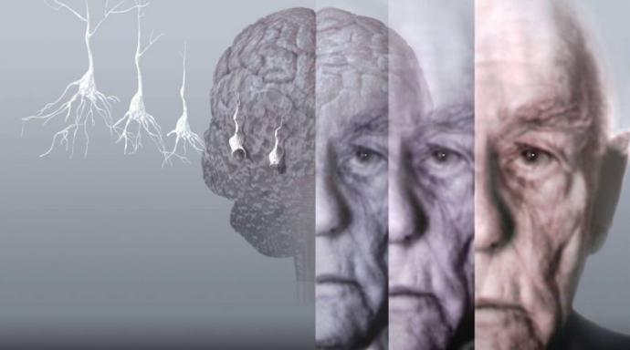 Alzheimer Hastaları ve Dövme Arasındaki Bağlantı