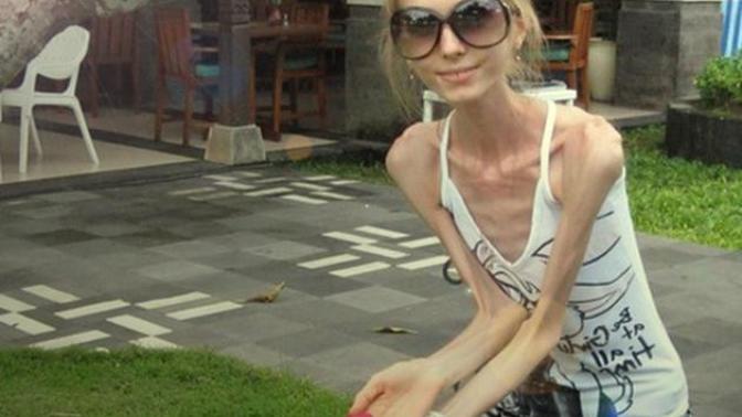 Diyet Takıntısı, Ölümcül Nervoza Hastalığına Götürüyor!