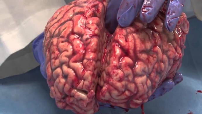 Yaşlıların Korkulu Rüyası Olan Alzheimer Hastalığını Önleme Yolları Nelerdir?