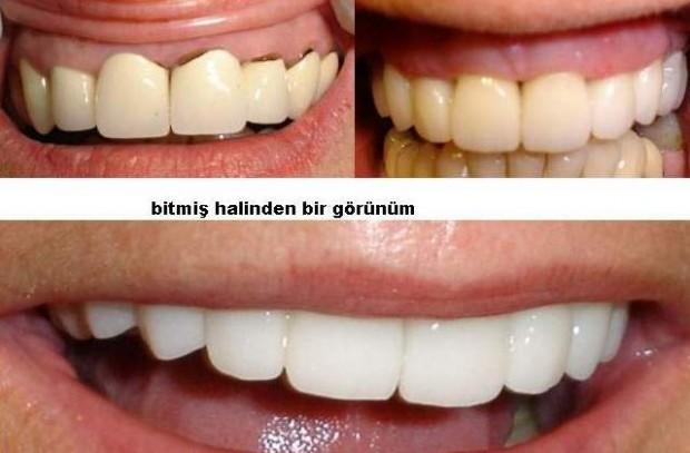 Dişlerine Kaplama Yaptıracak Olanları Nasıl Bir Süreç Bekliyor?