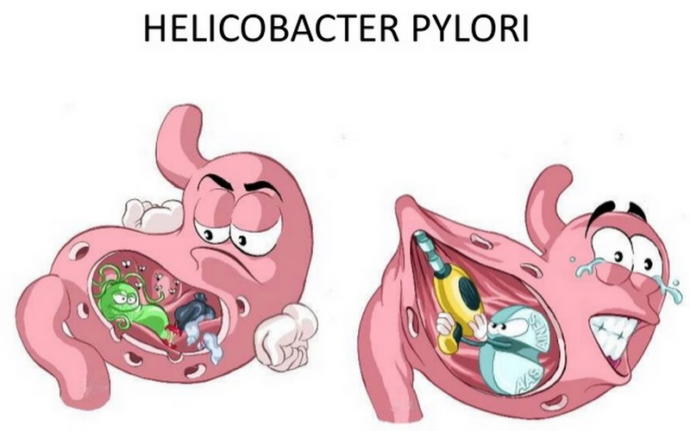 Mide Düşmanı Helikobakter Pilori Nedir?