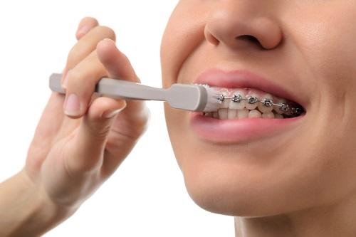 Diş Teli Kullanırken Ağız Sağlığı İçin Nelere Dikkat Edilmeli?