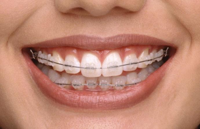 Diş Teli Kullanırken Ağız Sağlığı İçin Nelere Dikkat Edilmeli?