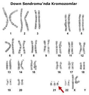 21 Mart Dünya Down Sendromu Günü, Down Sendromlu İnsanların Bizden +1 Farkı Nedir?