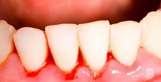 Diş Sağlığını Tehlikeye Atan Alışkanlıklar Nelerdir?