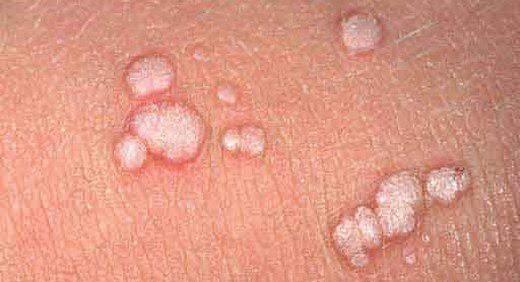 Virüsler ile Kanserin Bir İlişkisi Olabilir: Human Papilloma Virüsü