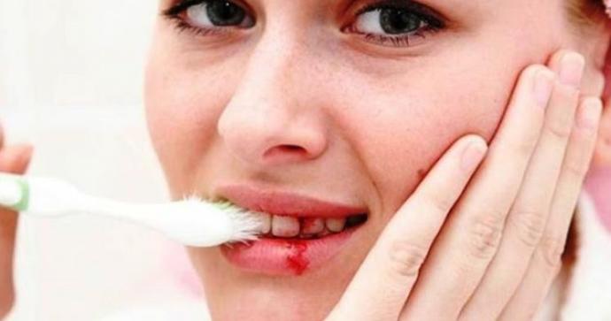 Diş Ve Ağız Sağlığının Baş Düşmanı Diş Taşları Neden Oluşur?