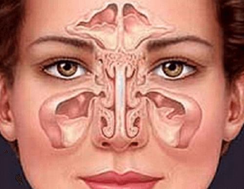 Sinüzit Kaynaklı Baş Ağrısı Nedir, Tedavisi Nasıl Sağlanır?