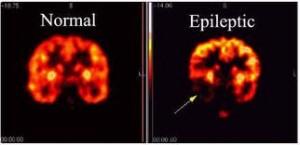Epilepsi Hakkında Doğru Bilinen Yanlışlar Nelerdir?
