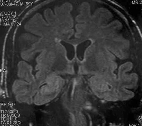 Epilepsi Hakkında Doğru Bilinen Yanlışlar Nelerdir?