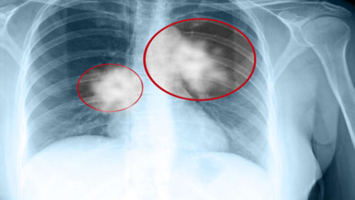Verem Nedir? Hastalığın 8 Belirtisine Dikkat!