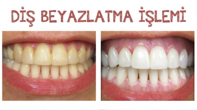 Bembeyaz Dişlere ve Güzel Bir Gülüşe Sahip Olmak İçin Neler Yapılmalıdır?