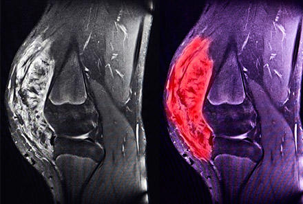 Bir Yavrunun Hayatını Söndüren Kemik Hastalığı: Osteosarkom!