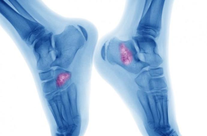 Bir Yavrunun Hayatını Söndüren Kemik Hastalığı: Osteosarkom!