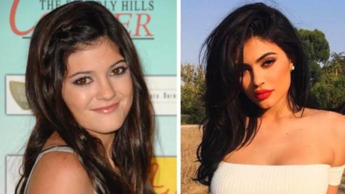 Bir Devir Sona mı Eriyor? Kylie Jenner Dudak Dolgularını Çıkardı Sosyal Medya Bununla Çalkalandı!