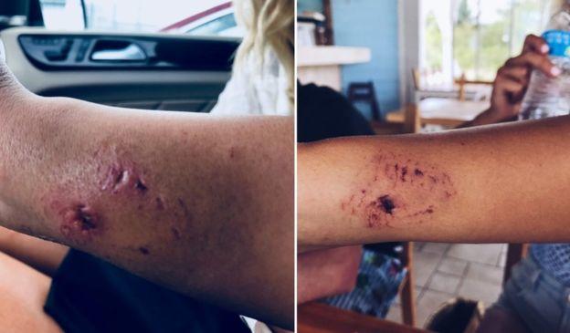 Güzel Modele Tatil Sırasında Köpek Balığı Saldırdı