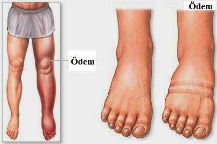 Ödemi Engellemek Adına Neler Yapılabilir?