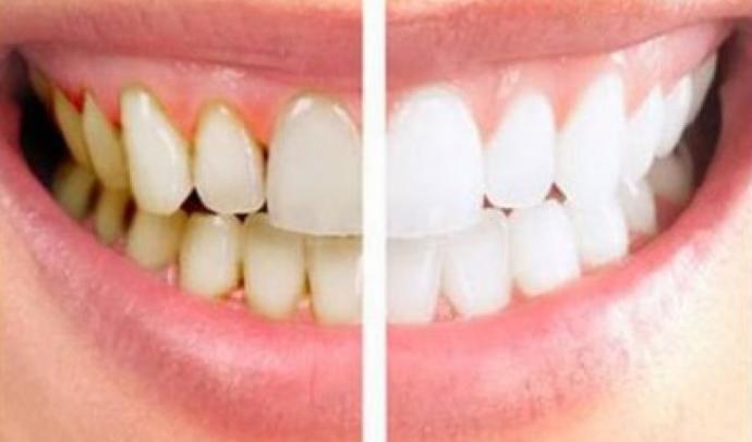Diş Eti Kanamaları Neden Oluşur ve Tedavisi İçin Neler Yapılmalıdır?