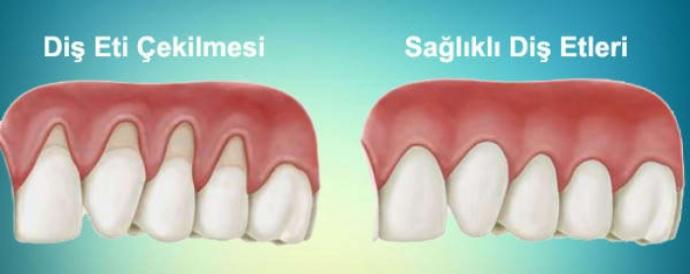 Diş Eti Kanamaları Neden Oluşur ve Tedavisi İçin Neler Yapılmalıdır?