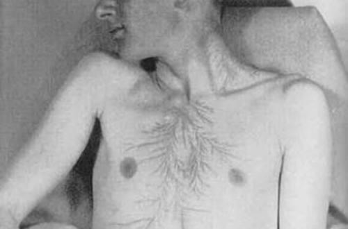 Yıldırımın Çarptığı İnsanlara Bıraktığı İzler: Lichtenberg Figürleri!