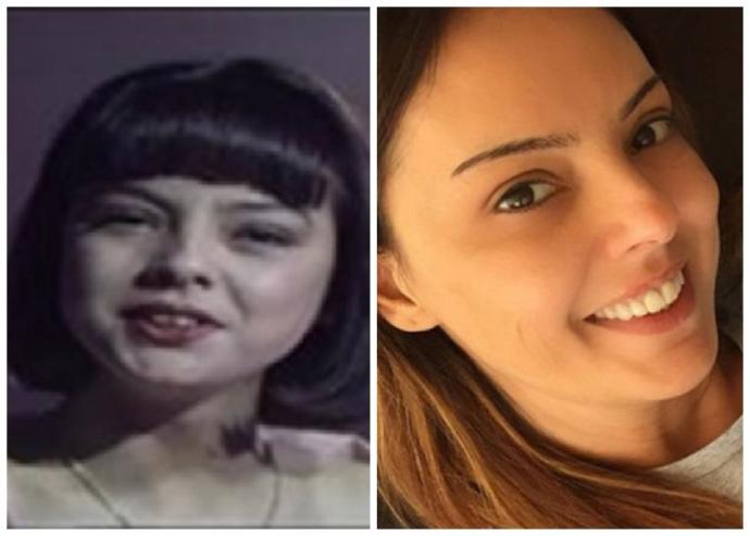 Ebru Gündeş'in eski ve yeni dişleri
