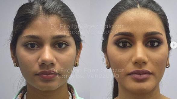 Venezuela Güzeli Estetik Yaptırmış