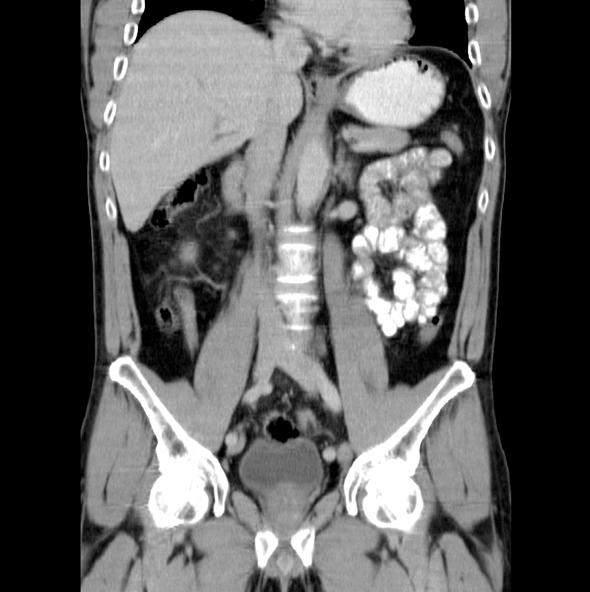 CT acil durumlarda, kist, tümör, kanser gibi durumlarda ve röntgenin yetersiz kaldığı kemik kırıklarında istenir. Kemik kırıklarında tomografi isteği nadirdir.