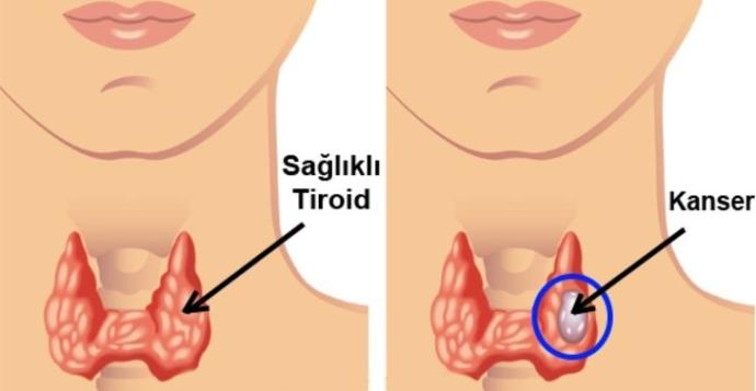 Çağımızın Giderek Yaygınlaşan Hastalığı Tiroit Nedir?