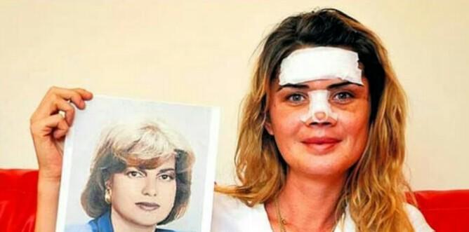 Kendisini Başka Ünlüye Benzetmek İçin Bıçak Altına Yatan 5 Ünlü!