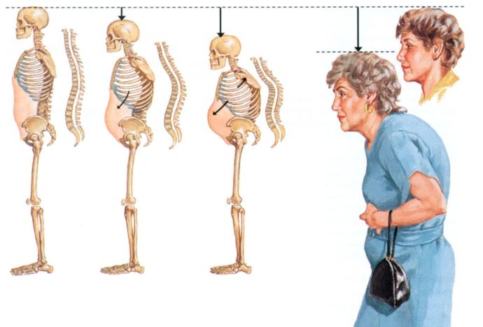 Aşırı Tuz Tüketimi Sonucu Oluşan Rahatsızlıklar Nelerdir?