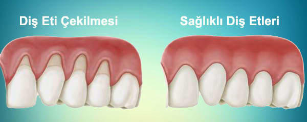 Diş eti çekilmesi