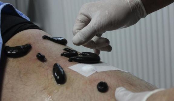Çağları Aşıp Gelen Mucize Doktor; Sülük