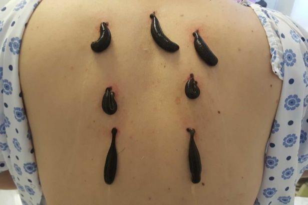Çağları Aşıp Gelen Mucize Doktor; Sülük