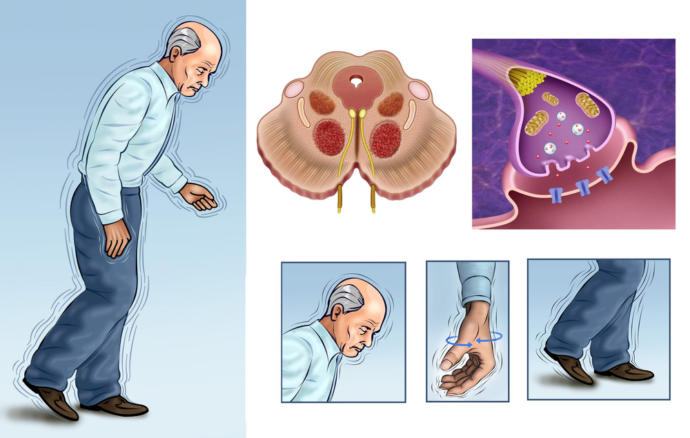 Dünya Parkinson Hastalığı Günü
