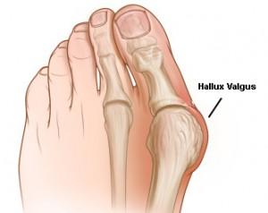 Önü Dar Ayakkabı Giyiniyorsanız Dikkat, Sizde De Halluks Valgus Olabilir!