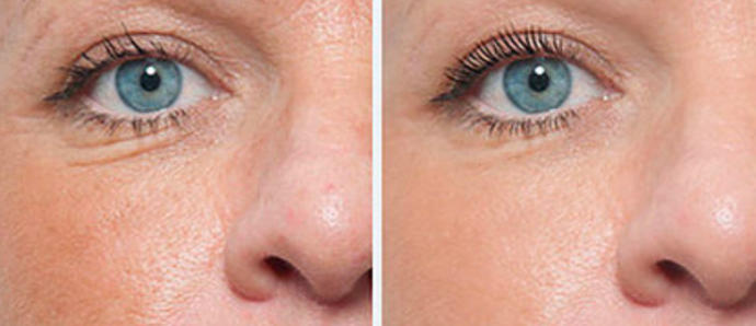 Araştırdım, Gittim ve Dermapen Yaptırdım: Dermapen Hakkında Her Şey!