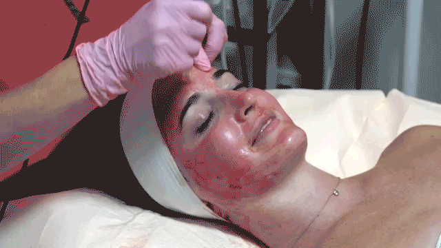 Araştırdım, Gittim ve Dermapen Yaptırdım: Dermapen Hakkında Her Şey!