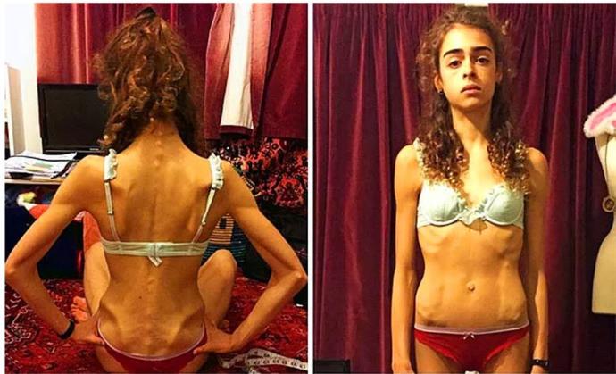 Anoreksiya Nervoza ve Bulimia Nervoza Nasıl Bir Hastalıktır?