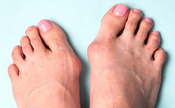Halluks Valgus